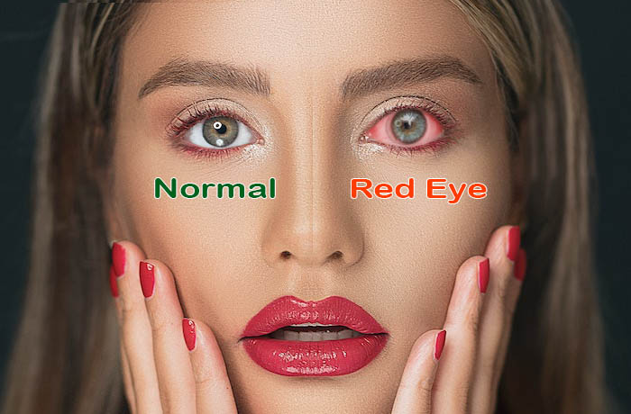 Common Causes of Sudden Red Eyes